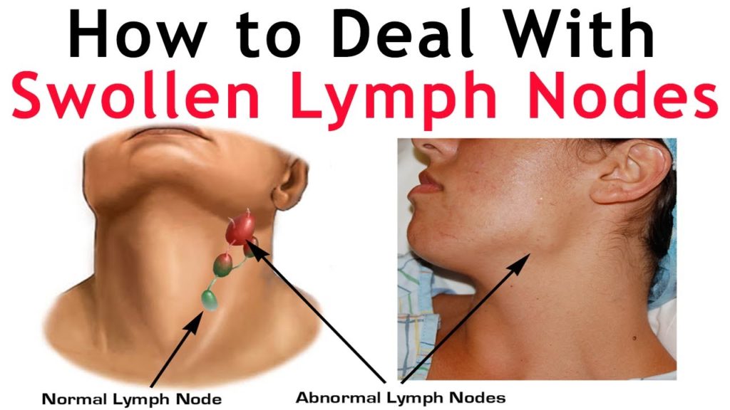Lymph Nodes or Swollen Glands with Fibromyalgia & ME/CFS