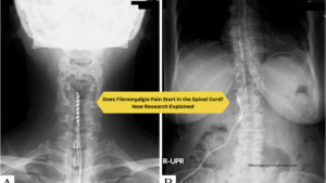 Does Fibromyalgia Pain Start in the Spinal Cord New Research Explained