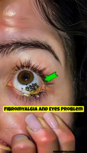 Fibromyalgia and eyes problem
