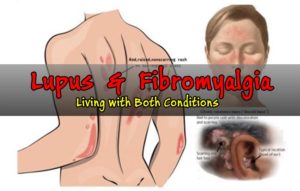 Lupus? How it is connected with Fibromyalgia