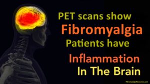 PET Scans show Fibromyalgia Patients have Inflammation in the Brain